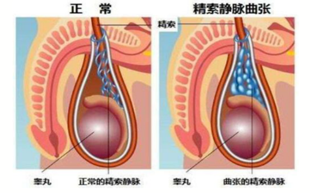 精索静脉曲张会影响生育吗？该如何治疗？