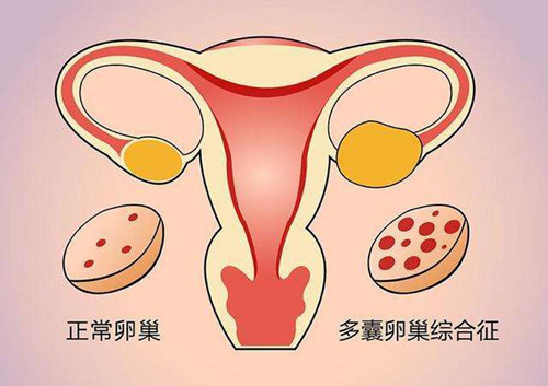 老婆得了多囊卵巢综合征会影响怀宝宝吗